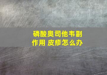 磷酸奥司他韦副作用 皮疹怎么办